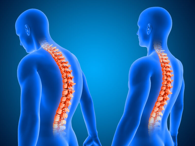 A Bradesco Saúde é obrigada a custear cirurgia de coluna?