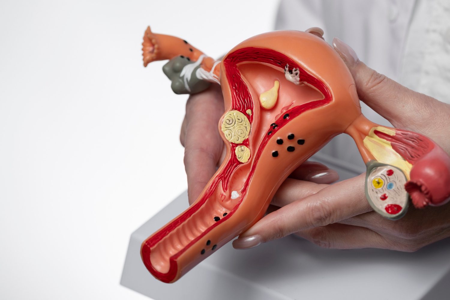 Cirurgia para endometriose deve ser custeada pelo Plano de Saúde