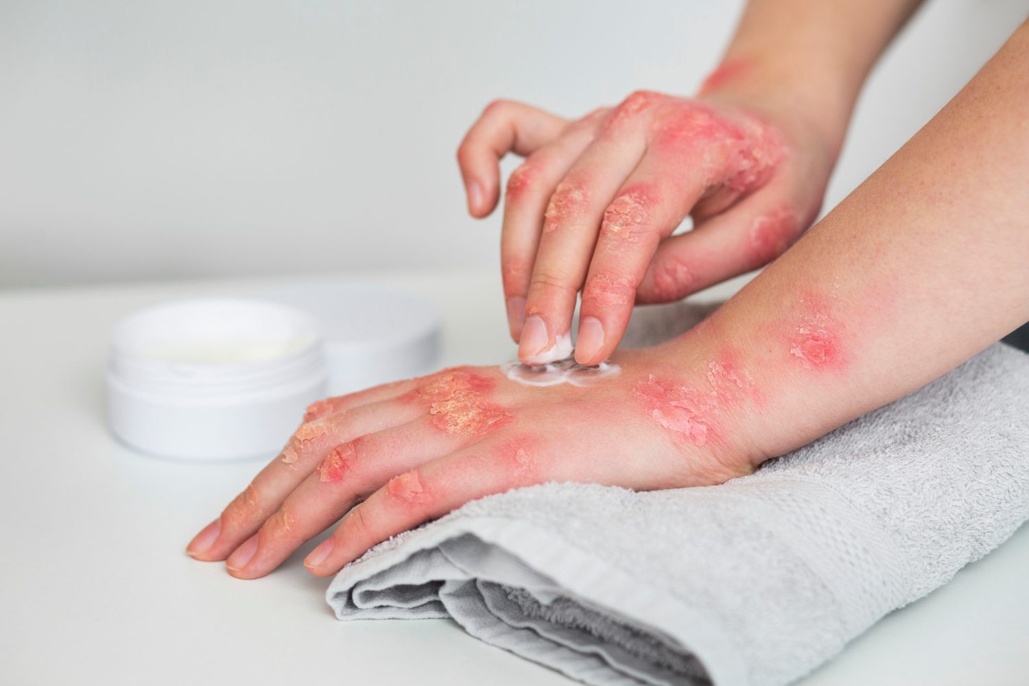 Lebrikizumabe plano de saúde é obrigado a fornecer o medicamento para dermatite atópica