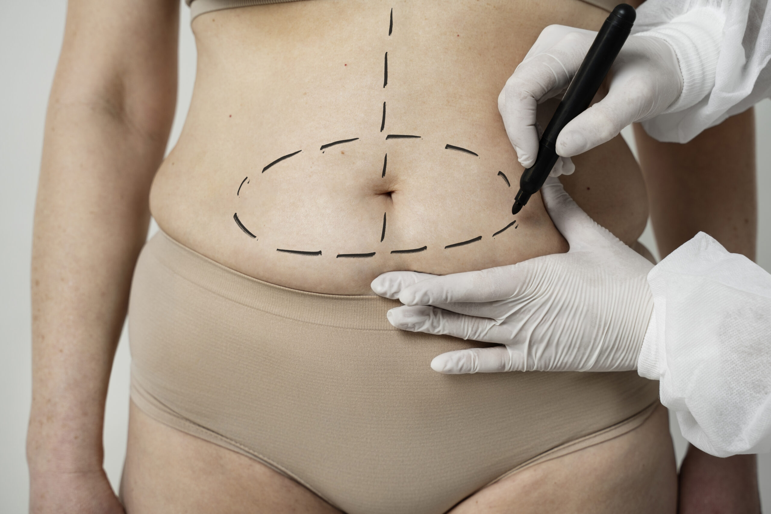 Cirurgia reparadora pós bariátrica plano de saúde