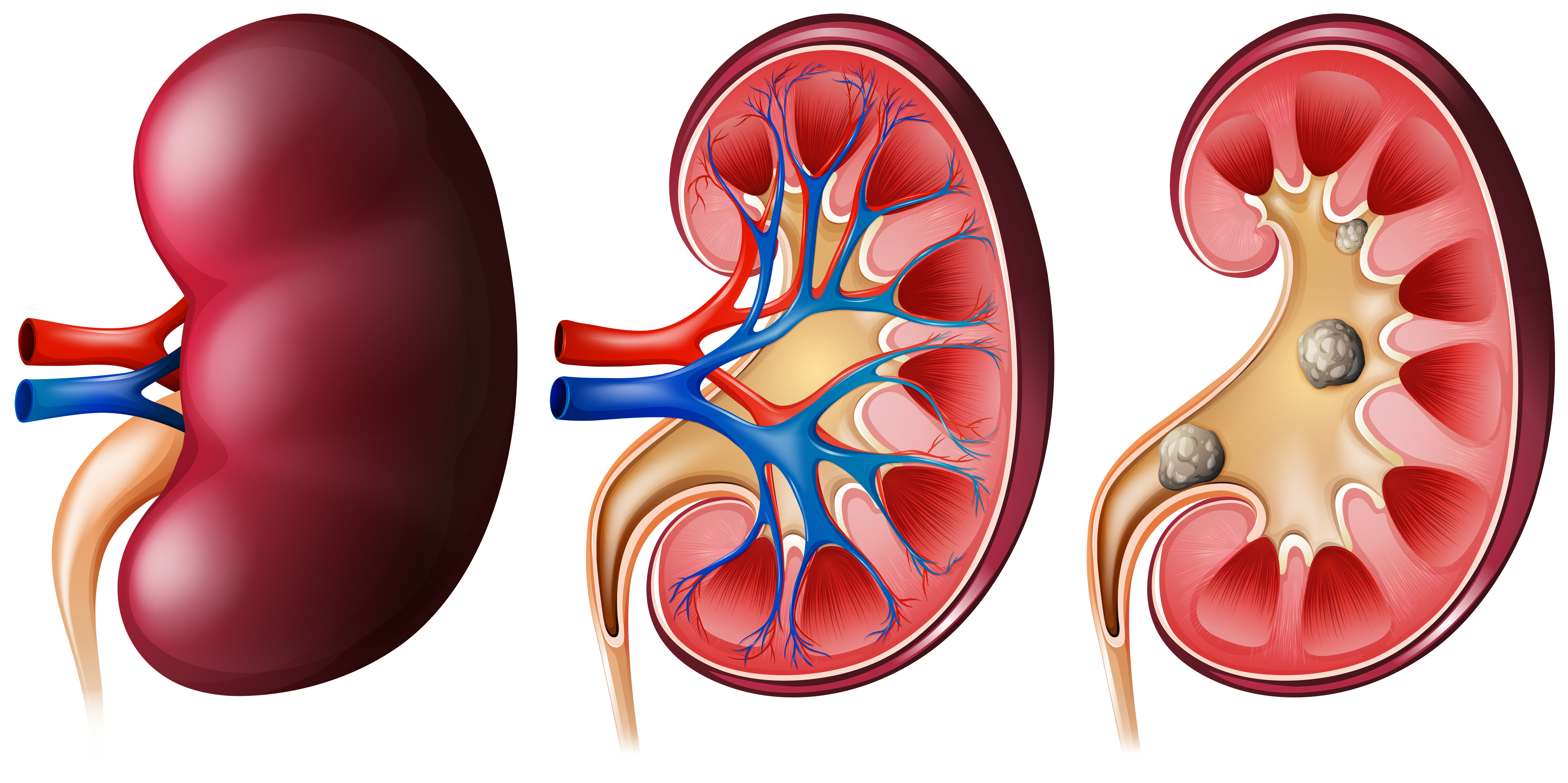 Plano de saúde deve custear cirurgia de cálculo renal