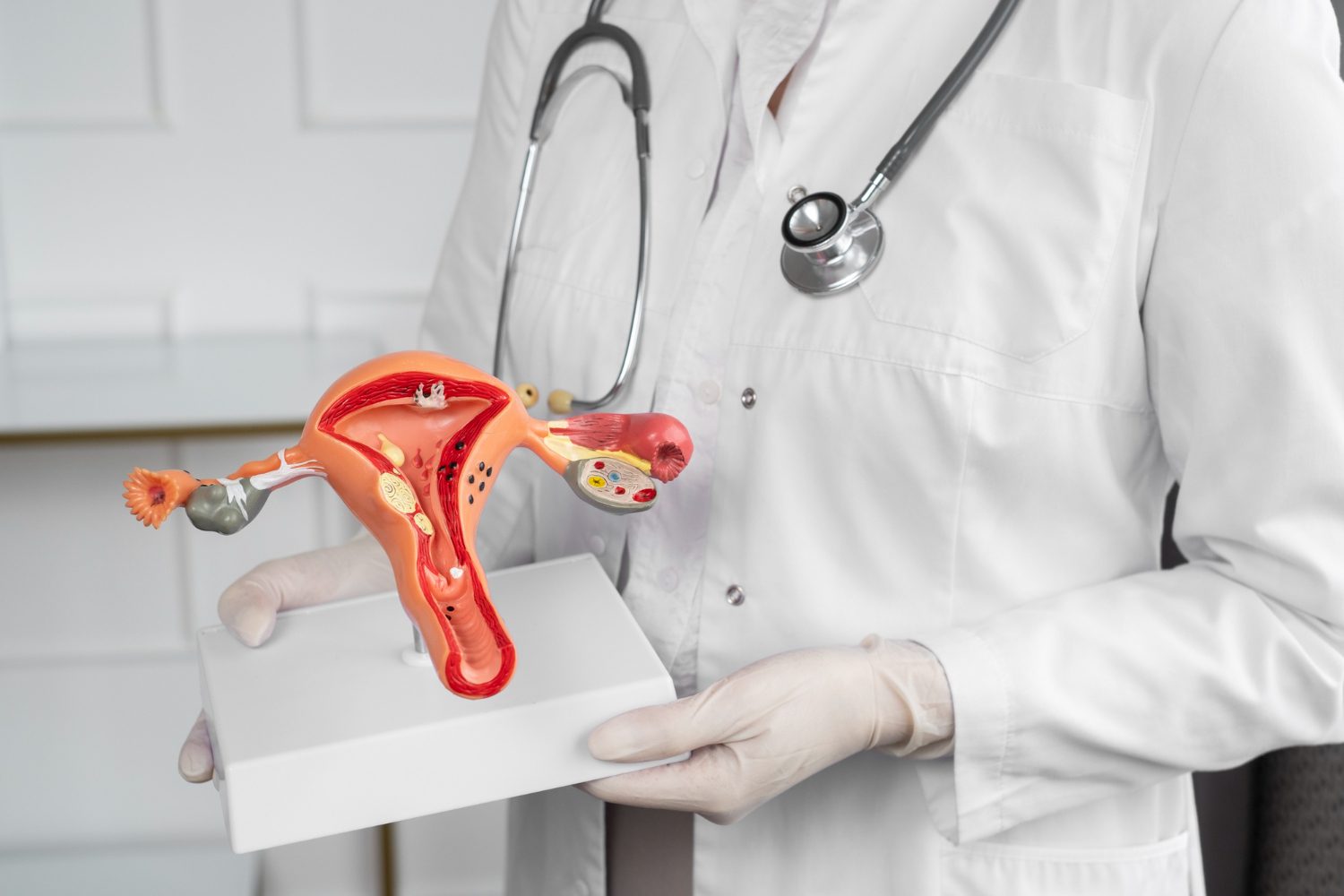 Plano de Saúde deve cobrir a Embolização de Mioma Uterino?