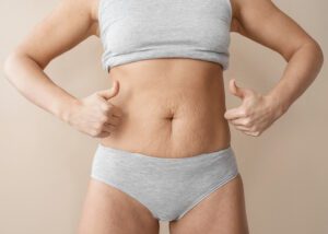 Cirurgia de Diástase deve ser custeada pelo Plano de Saúde?