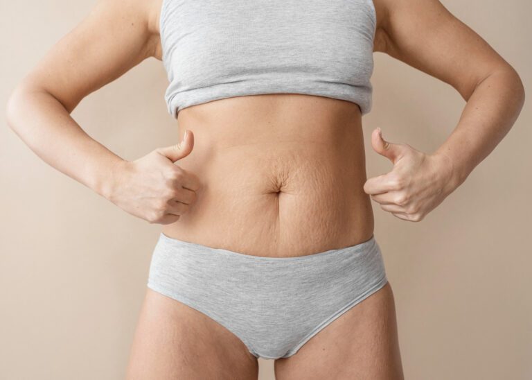 Cirurgia de Diástase deve ser custeada pelo Plano de Saúde?