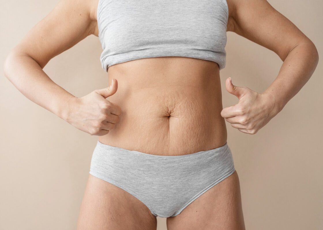 Cirurgia de Diástase deve ser custeada pelo Plano de Saúde?