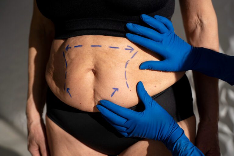 A abdominoplastia deve ser custeada pelo Plano de Saúde?