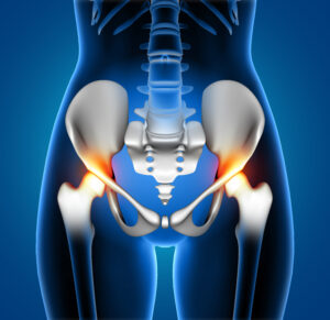 Artroplastia total de quadril custeada pelo Plano de Saúde?