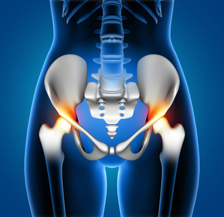 Artroplastia total de quadril custeada pelo Plano de Saúde?